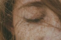 Врач рассказала о признаках опасных веснушек