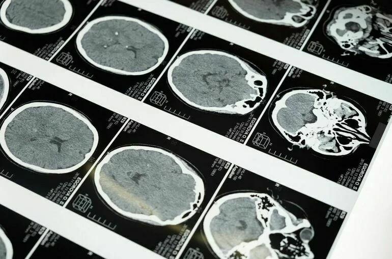Болезни нервной системы занимают третье место среди причин смертности у россиян