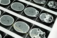 Болезни нервной системы занимают третье место среди причин смертности у россиян