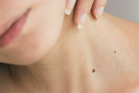 Врач развеяла миф о похожих на родинки красных пятнах на коже