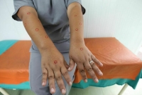 Вирусолог назвала симптомы оспы обезьян