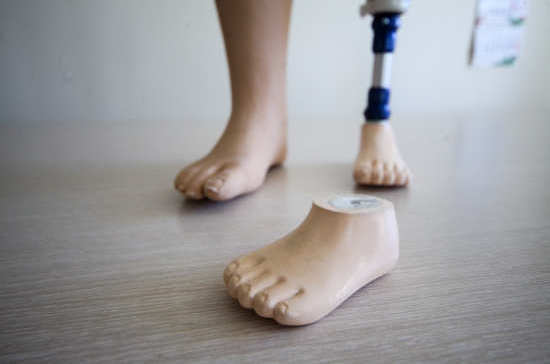 Почему инвалидам не хватало протезов 