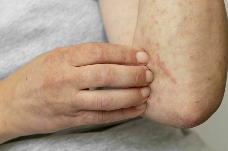 В МГУ выявили случай заболевания корью